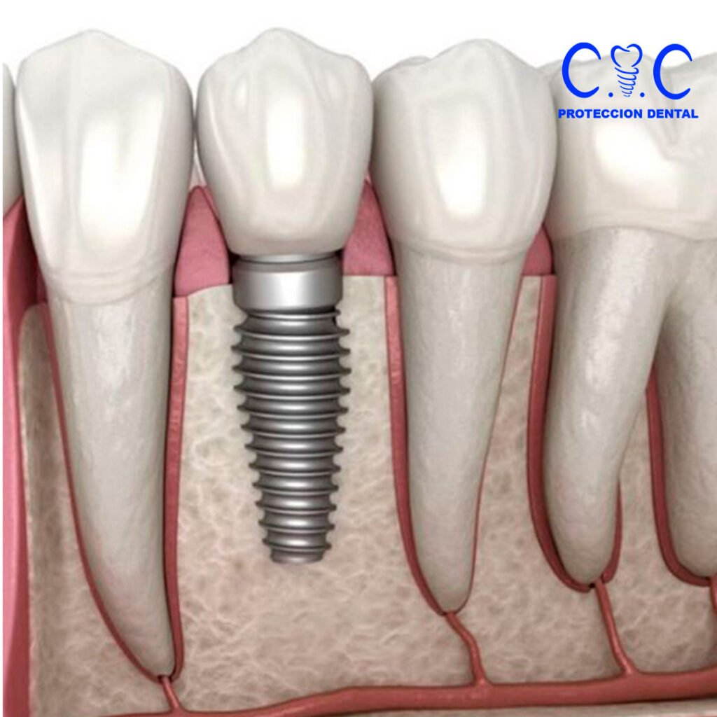 implante dental